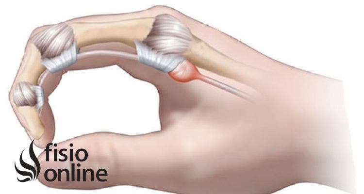Tengo dolor en el dedo medio de la mano derecha